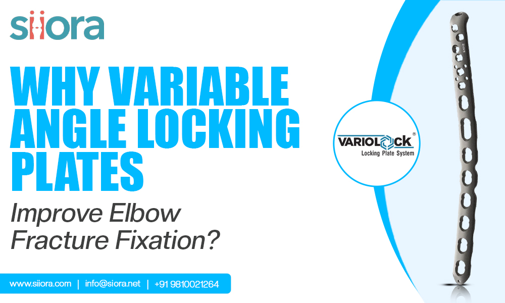 Why Variable Angle Locking Plates Improve Elbow Fracture Fixation